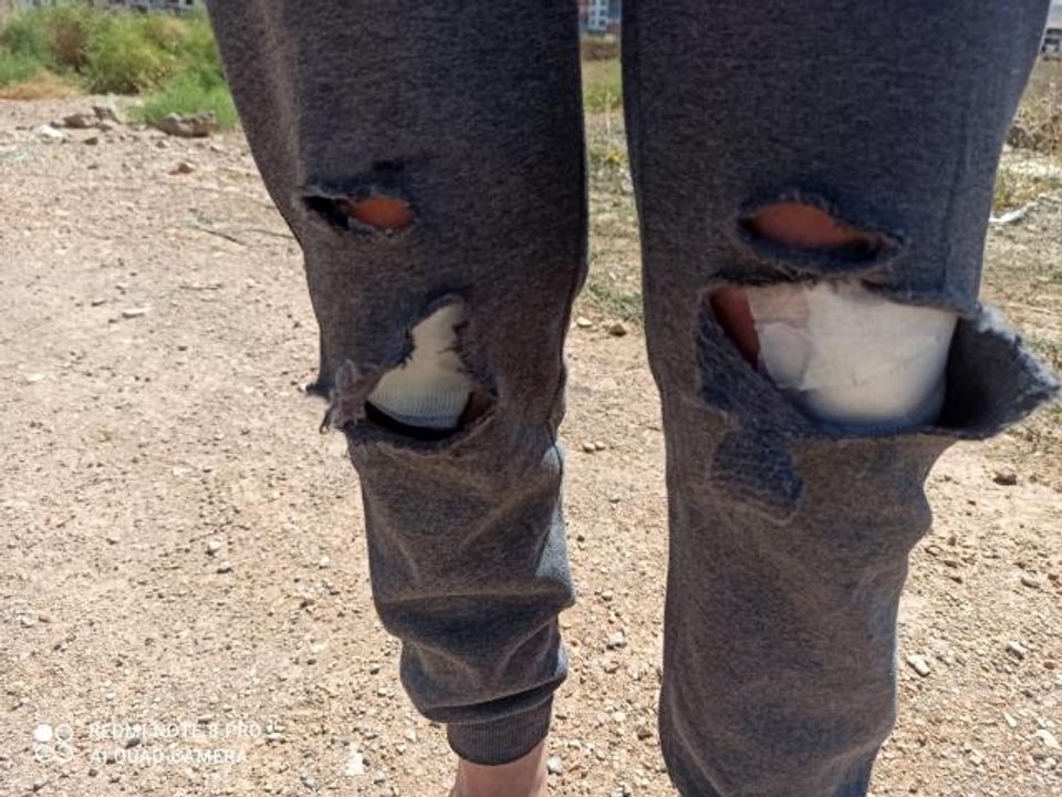 Başkent'te başıboş köpeklerin saldırısına uğrayan kadın canını zor kurtardı