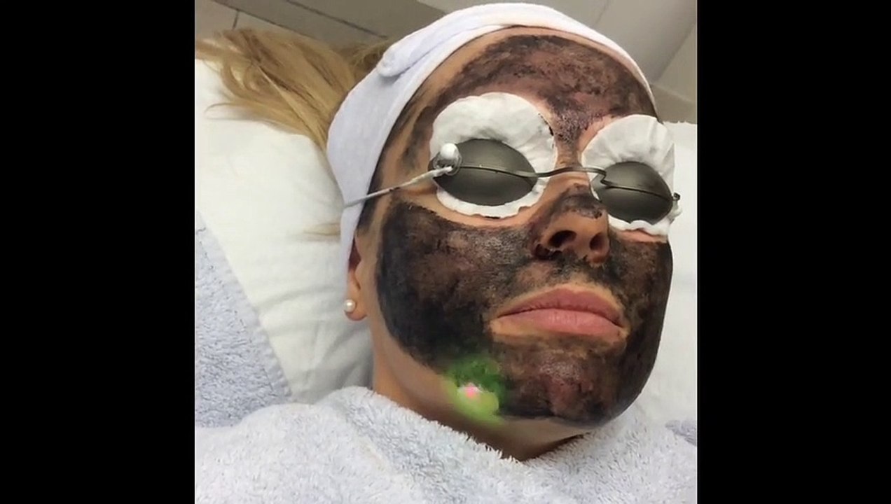 Carbon Facial