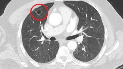 Dünya tıp literatüründe bir ilk: Covid-19, akciğer kanserini taklit etti