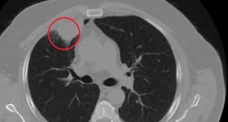 Dünya tıp literatüründe bir ilk: Kovid-19, akciğer kanserini taklit etti