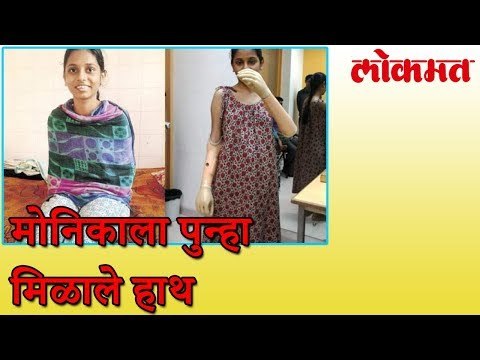 Monica More ला मदतीचे हात | Monica Can Write With The Prosthetic Arms | लोकमत मराठी न्यूज़