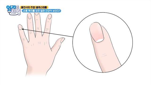 똑똑하게 혈관 건강 체크하는 법! 손톱 뿌리를 봐라?!