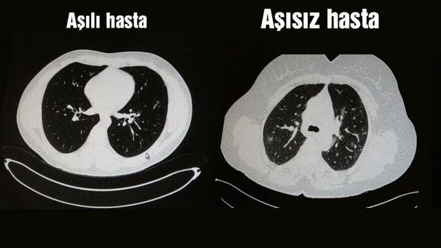 Akciğer tomografisi korkunç gerçeği gözler önüne serdi!