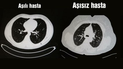 Akciğer tomografisi korkunç gerçeği gözler önüne serdi!