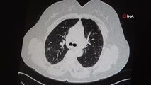 Aşılı ve aşısız olarak koronaya yakalanan 2 gencin akciğer tomografisi korkunç gerçeği gözler önüne serdi