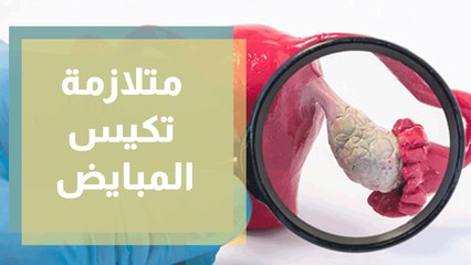 متلازمة تكيس المبايض
