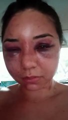 Suspeito de graves agressões contra jovem de Tapejara é considerado foragido