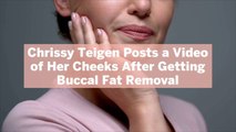 Chrissy Teigen Posts a Video of Her Cheeks After Getting Buccal Fat Removal—Here's What That Is