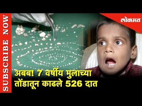 अबब! मुलाच्या तोंडातून काढले 526 दात | 526 Teeth Removed | Lokmat