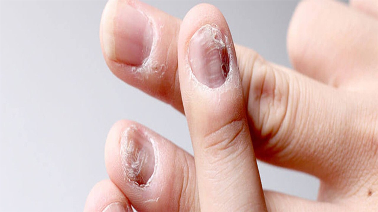 Nails के पास गड्ढें क्यों होते है । नाखून के गड्ढों का घरेलू इलाज । Pitted Nails Remedies । Boldsky
