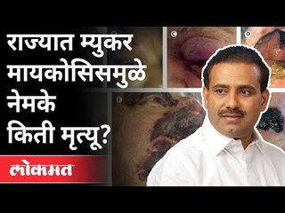 राज्यातली Myucor mycosis ची स्थिती काय?  Rajesh Tope On Mucor Mycosis | Maharashtra News