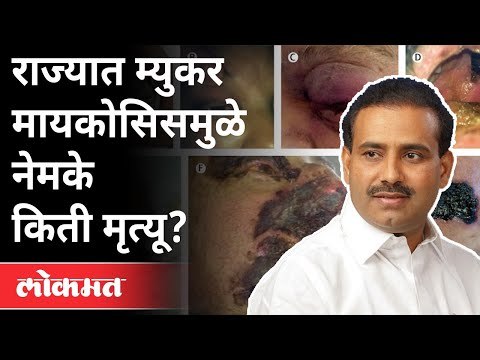 राज्यातली Myucor mycosis ची स्थिती काय? Rajesh Tope On Mucor Mycosis | Maharashtra News