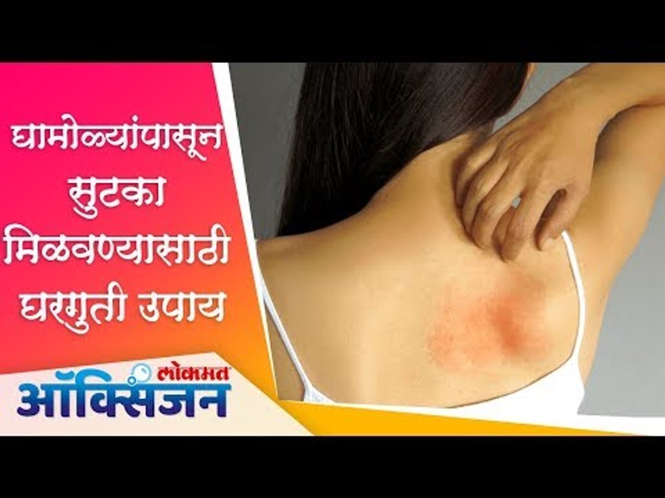 घामोळे कमी  करण्यासाठी घरगुती उपाय | Fungal Infection | Home Remedies | Lokmat Oxygen