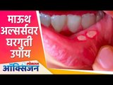 माऊथ अल्सर्सवर घरगुती उपाय! | Mouth Ulcer | Home Remedy |  Lokmat Oxygen