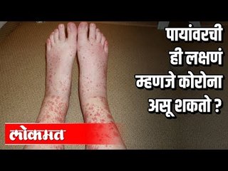 पायांवरची ही लक्षणं म्हणजे कोरोना असू शकतो? Coronavirus Symptoms
