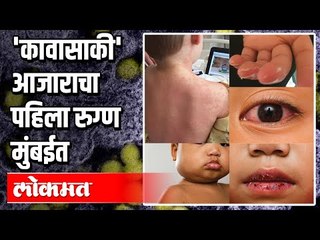 कावासाकी आजाराची लक्षण | First Kawasaki Case in Mumbai | Lockdown Updates