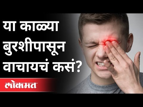 Myucormycosis आहे तरी काय? उपाय काय? What is Mucormycosis? Remedy against Myucornmycosis? Covid19