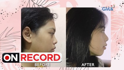 On Record: MEWING AT NOSE-PINCHING, NAKAPAGPAPABAGO NGA BA NG ITSURA?