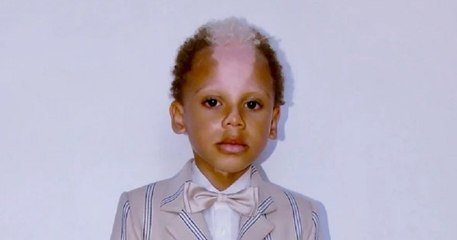 Atteint de piébaldisme, ce jeune garçon devenu mannequin incarne « le visage de l'acceptation »