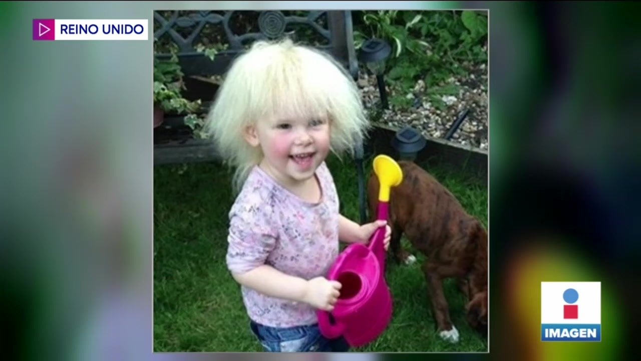 Lyla padece el síndrome del cabello impeinable igual que Albert Einstein