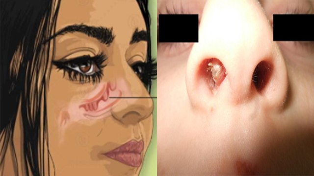 नाक का मांस क्यों बढ़ता है । नाक का मांस बढ़ने का लक्षण । नाक का मांस बढ़ने का उपाय । Boldsky