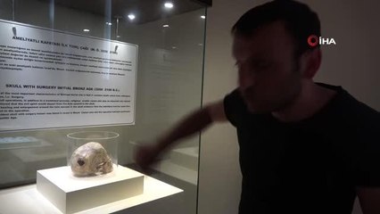 3 bin yıllık kafatasında ameliyat izi