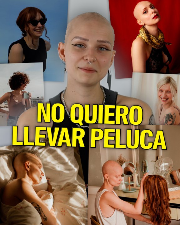 ¿Cómo es vivir con alopecia femenina?