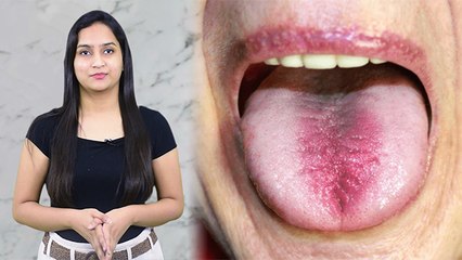 इस Vitamin की कमी से Mouth में हो सकती है ये खतरनाक बीमारी; Watch Video | Boldsky