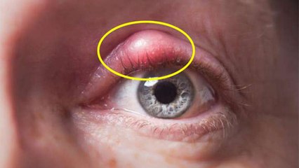 पलकों पर गांठ क्यों होती है। पलकों की गांठ ठीक करने का उपाय । Remedy for lump of eyelashes। Boldsky