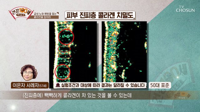 콜라겐 부족➜ 만성 염증 까지? 콜라겐 감소로 인한 질병✓ TV CHOSUN 210927 방송