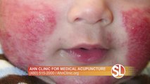 Dr Yang Ahn treats children with Atopic Dermatitis using medical acupuncture