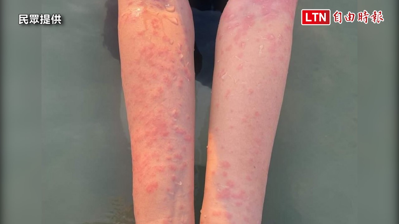 澎湖爆發大規模皮膚紅腫怪病 民眾自扮柯南