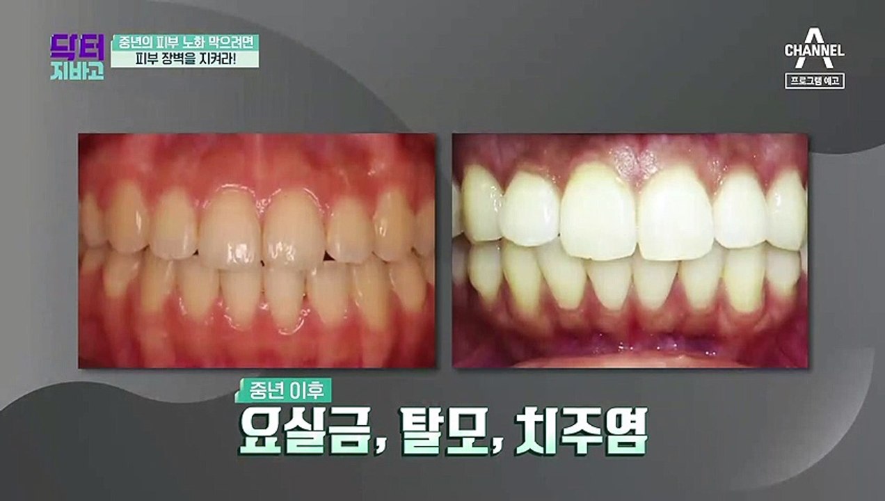 [예고] 요실금, 탈모, 피부노화의 원인이 되는 콜라겐 부족?! 피부 건강 지키고 동...