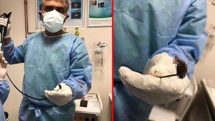 Öksürük şikayetiyle doktora giden hastanın akciğerinden kabak çekirdeği çıktı