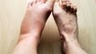 पैरों में सूजन है खतरनाक नजरअंदाज, पड़ सकता है भारी जानिए लक्षण और उपाय । Boldsky