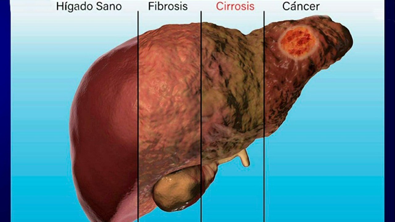 bd-cirrosis-causas-sintomas-y-tratamientos-041021