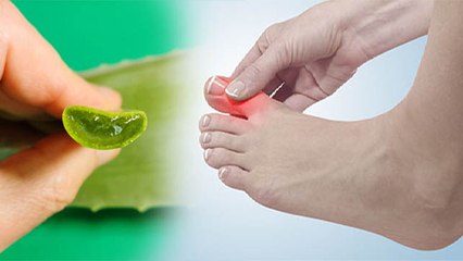 Uric Acid का Aloevera से जबरदस्त Treatment, ऐसे करें सेवन | Boldsky