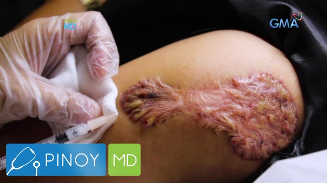 Pinoy MD: Keloid, paano nga ba maiiwasan?