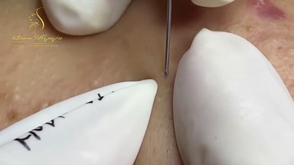 Blackhead Removal #1