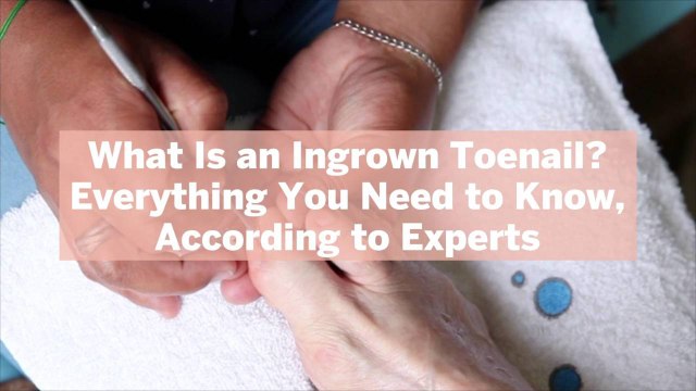What Is an Ingrown Toenail? Everything You Need to Know, According to Experts