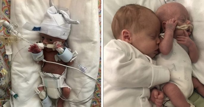 Royaume-Uni : un bébé prématuré ne pesant que 485 grammes a continué à se battre grâce aux câlins de son frère jumeau