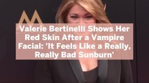 Valerie Bertinelli Shows Her Red Skin After a Vampire Facial: 'It Feels Like a Really, Really Bad Sunburn'