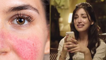 Yami Gautam को Keratosis Pilaris जैसी लाइलाज बीमारी , जानिए इसके Symptoms और उपाय । Boldsky