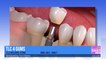 Tooth Replacement Options with TLC 4 Gums