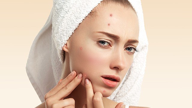 Redakan Jerawat dalam Semalam dengan Cara Ini