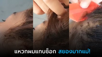 สาวคันหัว ไปหาหมอดูอาการ พอแหวกผมเท่านั้นแหละ แม่เจ้า.. ยั้วเยี้ยเต็มไปหมด !!