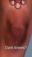 Reduce dark sport from Knee only on everytimemasti