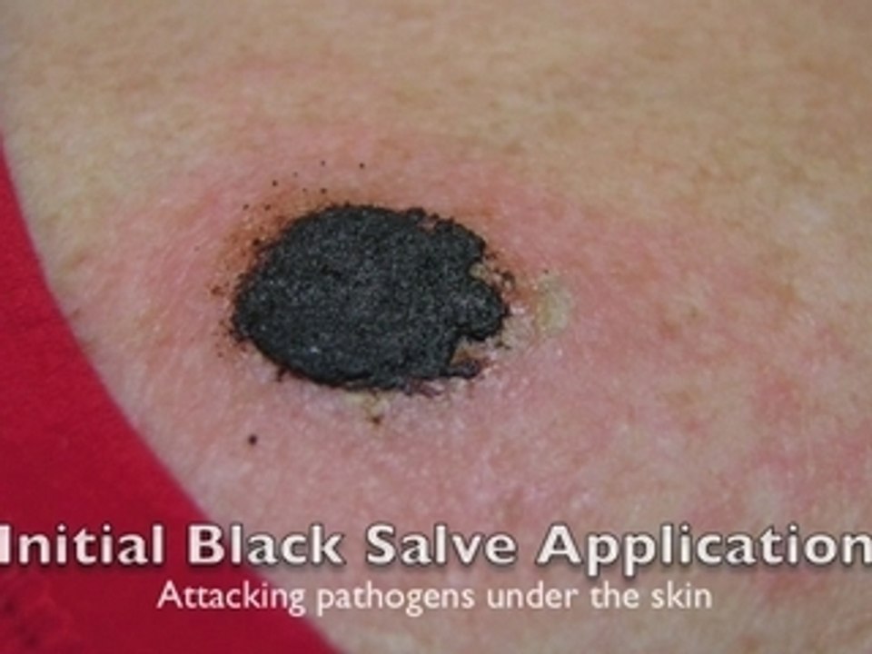 Video of Squamous Cell Cancer Treated with Black Salve