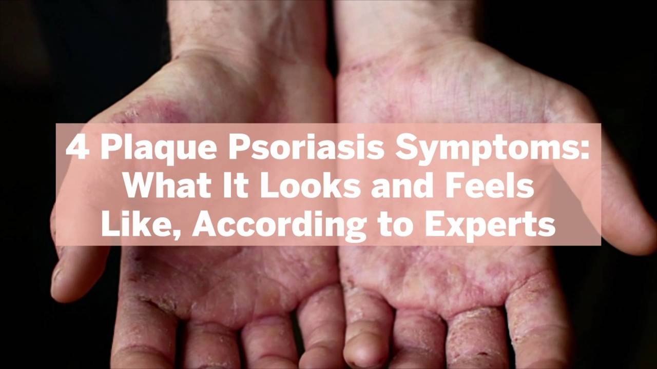 4 Plaque Psoriasis Symptoms: What It Looks and Feels Like, According to Experts