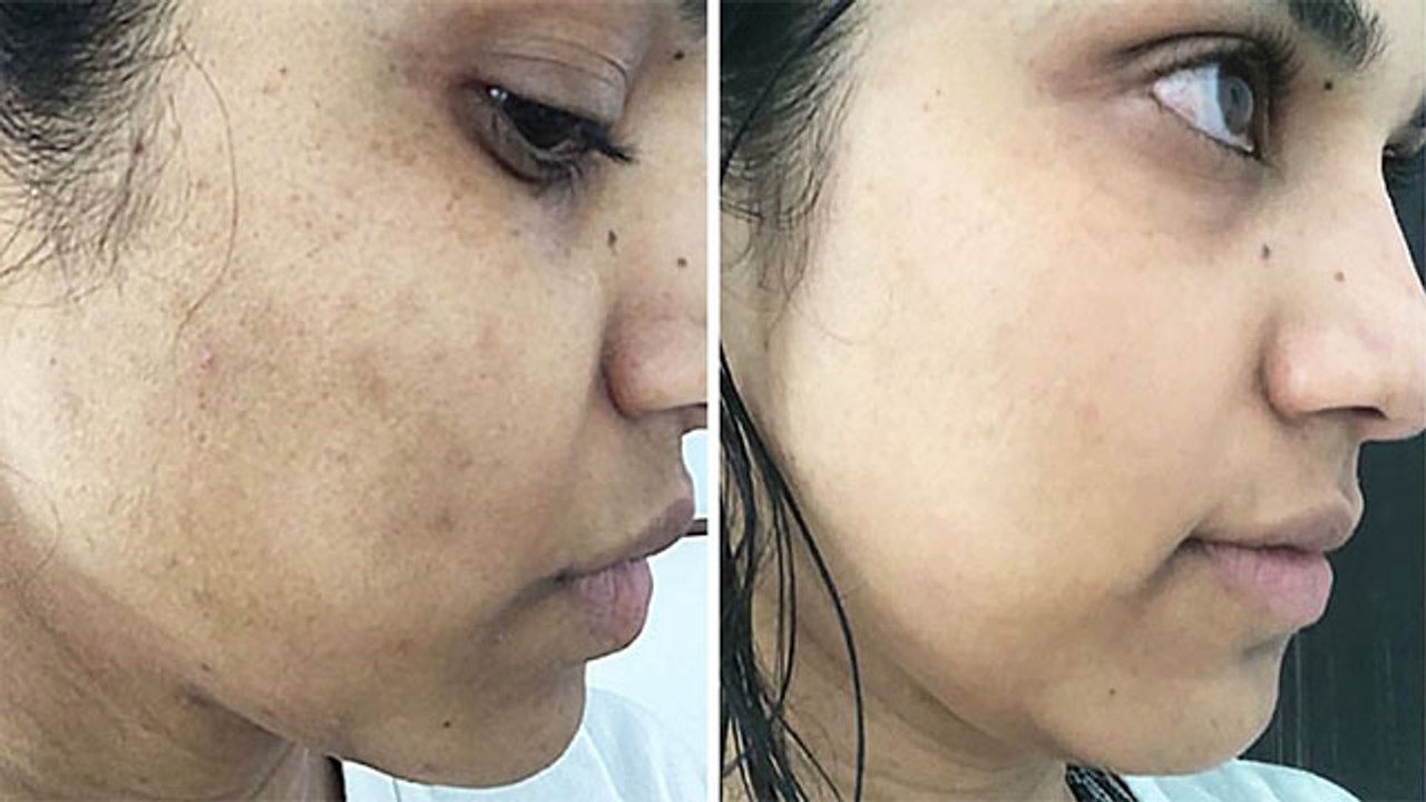 Face पर Brown Spots होने की बड़ी वजह चौंका देगी...